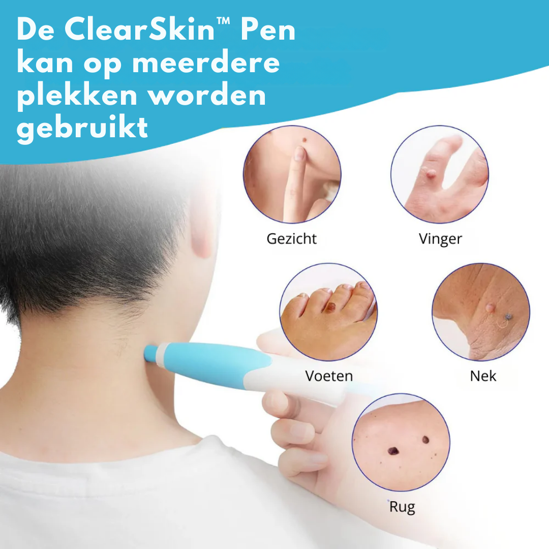ClearSkin™ Pen – Veilig & Effectief Wrattenverwijder