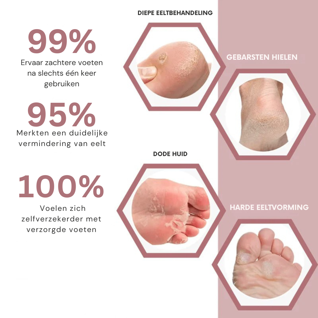 VelvetFeet™ Pro – Elektrische Eeltvijl voor Zachte & Gladde Voeten