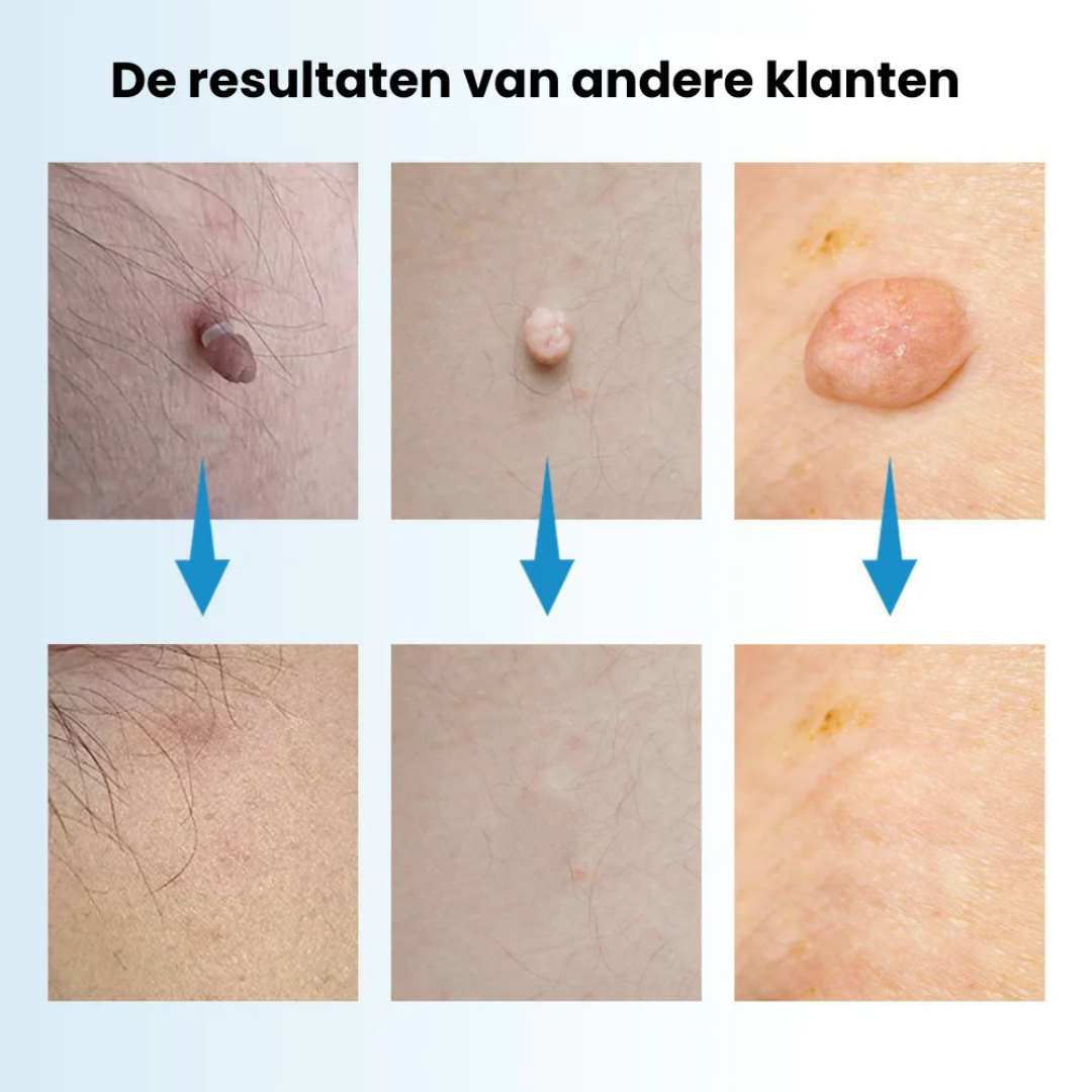 ClearSkin™ Pen – Veilig & Effectief Wrattenverwijder