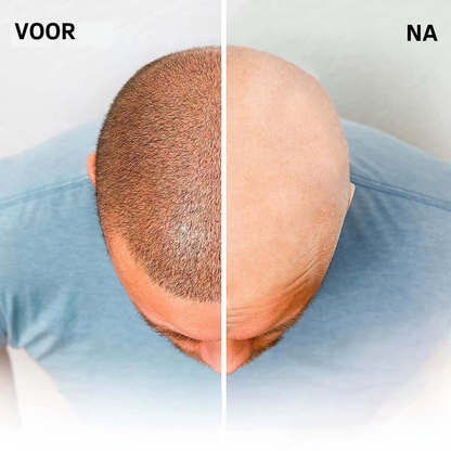 SmoothDome™ Pro – 5D Hoofd- & Gezichtsscheerapparaat