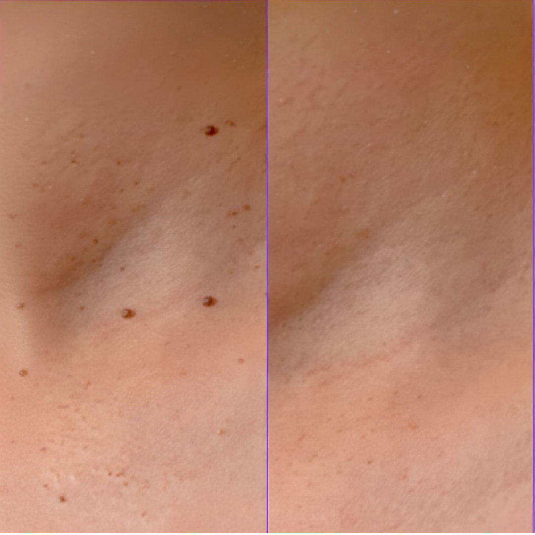 ClearSkin™ Pen – Veilig & Effectief Wrattenverwijder