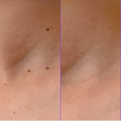 ClearSkin™ Pen – Veilig & Effectief Wrattenverwijder